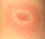 A 'bulls-eye' rash characteristic of Lyme disease